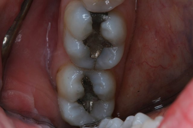 Silver Filling Replacement Before